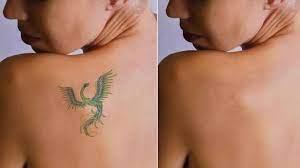 Permanent Tattoo Removal in Delhi is possible, but there is a lot of depth to it. 	 - Img 1