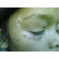 Arogyam pure herbs kit for vitiligo