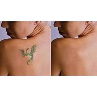 Permanent Tattoo Removal in Delhi is possible, but there is a lot of depth to it. 	