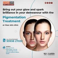 Laser Treatment For Birthmark Removal In hyderabad